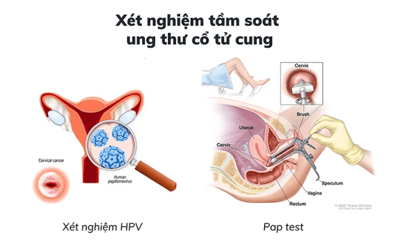 tam-soat-ung-thu-co-tu-cung