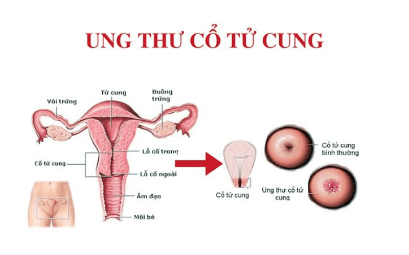 tam-soat-ung-thu-co-tu-cung