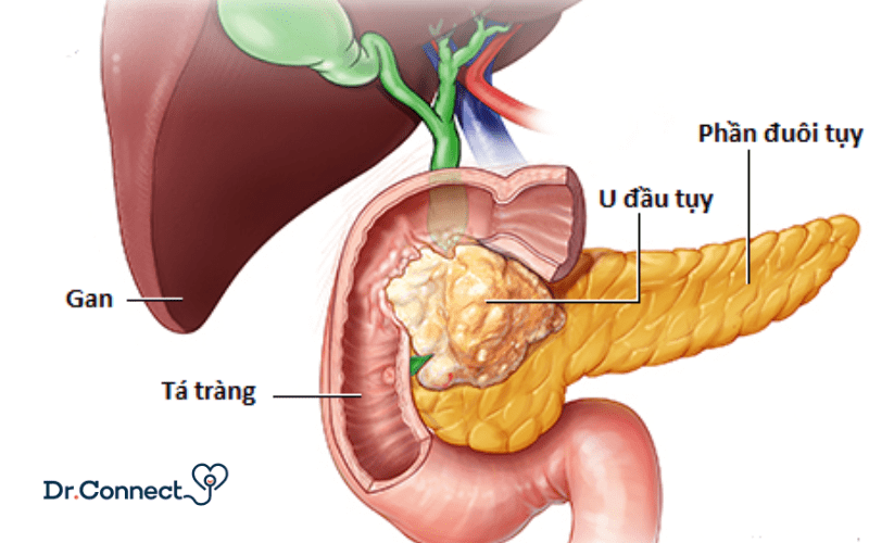 ung-thu-tuyen-tuy