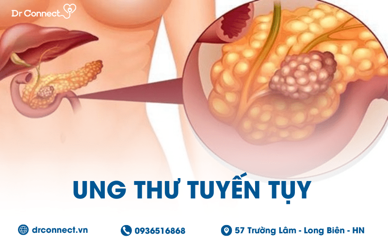 ung-thu-tuyen-tuy